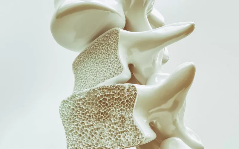 imagem ilustrativa de ossos da coluna com Osteoporose